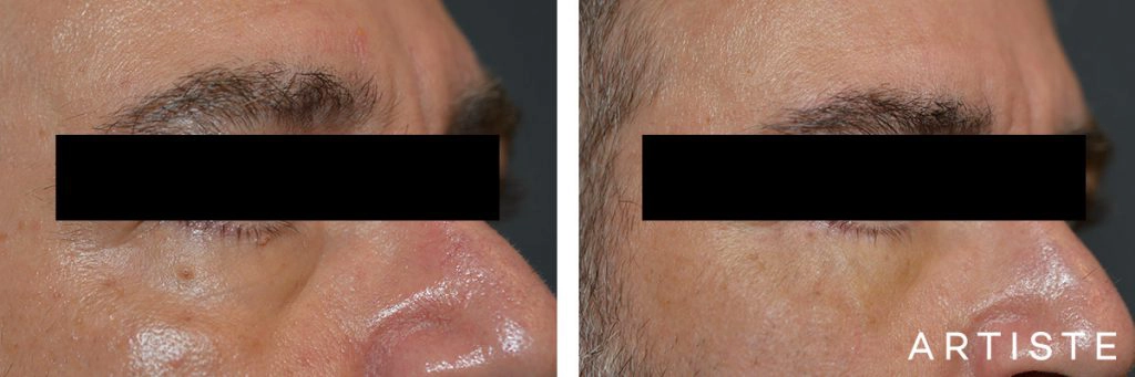 53 Year Old Lower Eyelid Blepharoplasty