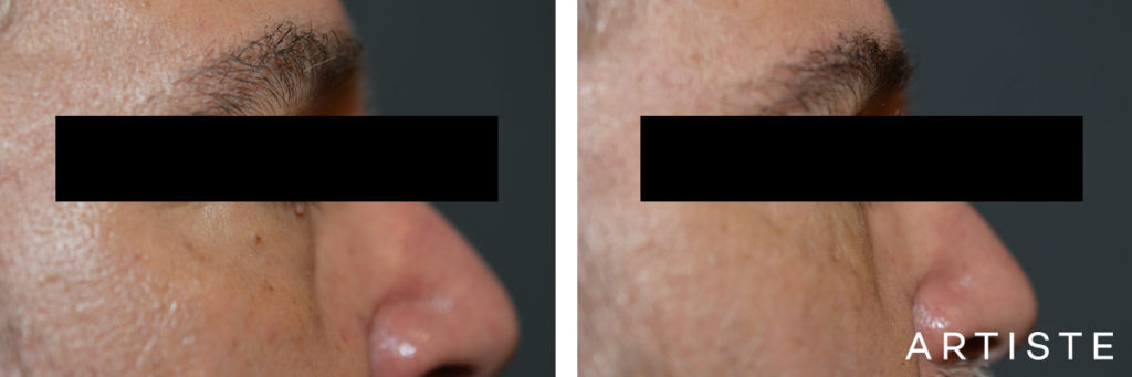53 Year Old Lower Eyelid Blepharoplasty