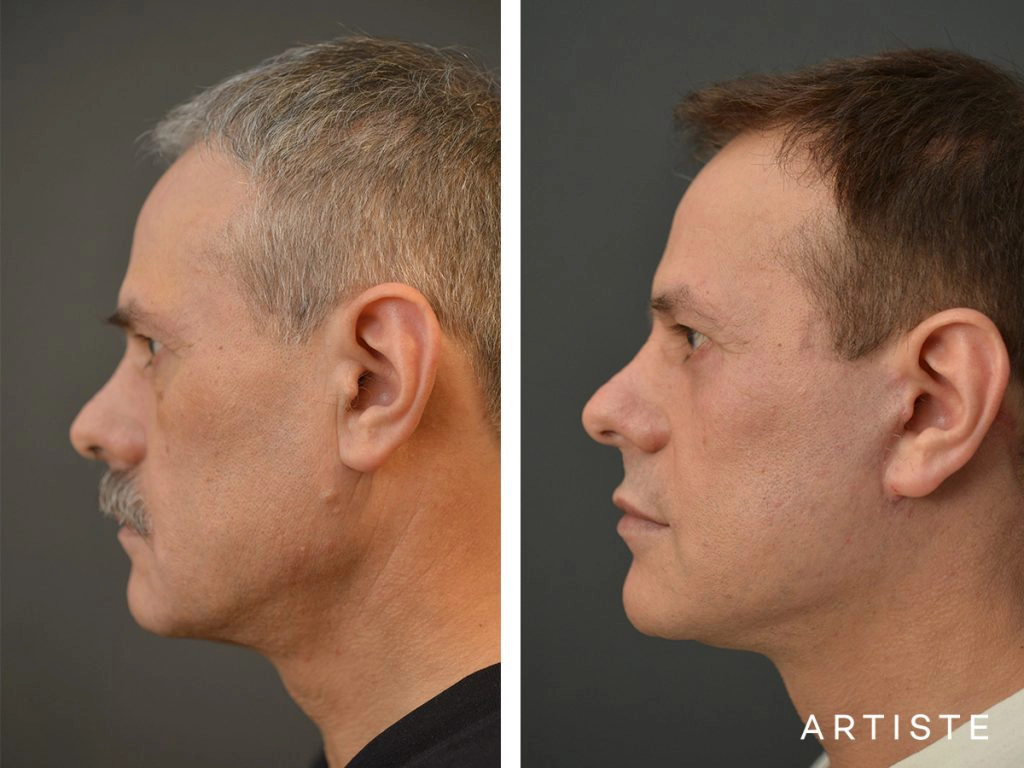 53 Years Old Male Facelift and Lower Eyelids: Artiste Deep Plane Facelift, Lower Eyelid Blepharoplasty