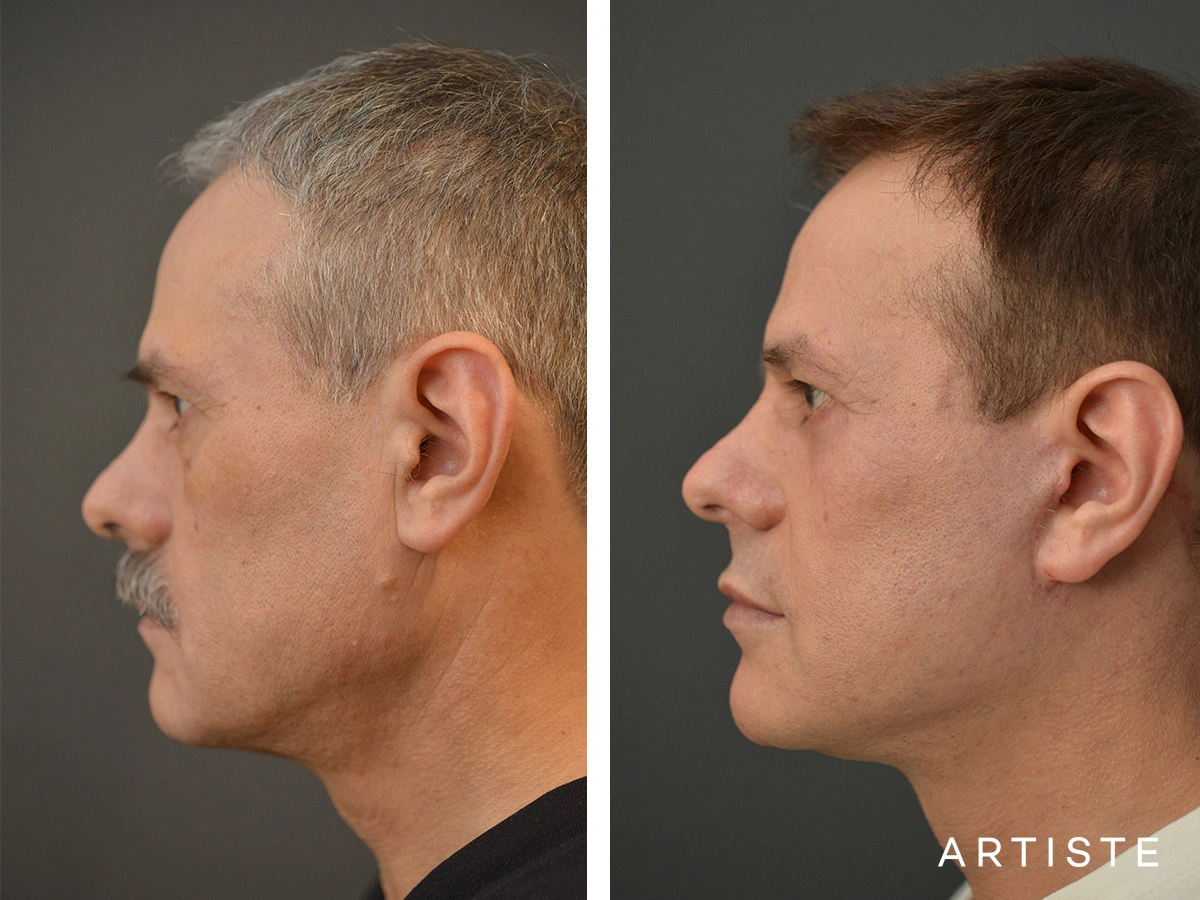 53 Years Old Male Facelift and Lower Eyelids