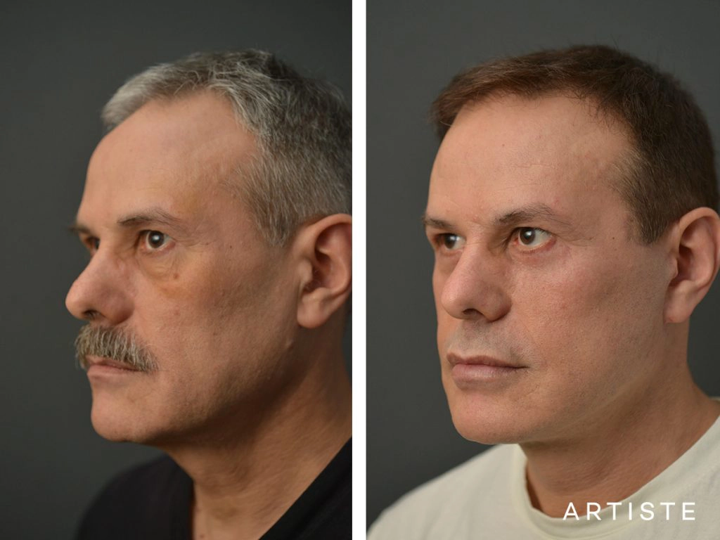 53 Years Old Male Facelift and Lower Eyelids: Artiste Deep Plane Facelift, Lower Eyelid Blepharoplasty