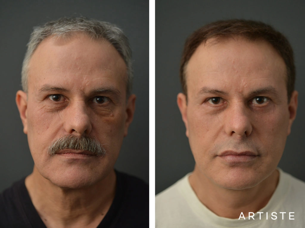 53 Years Old Male Facelift and Lower Eyelids: Artiste Deep Plane Facelift, Lower Eyelid Blepharoplasty