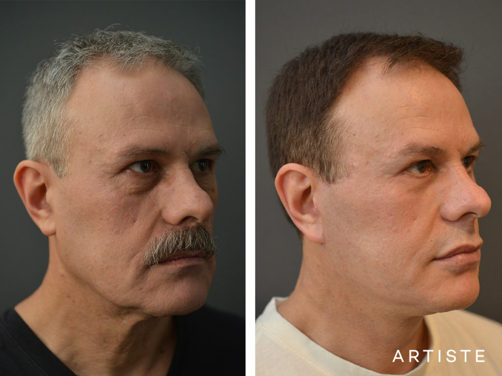 53 Years Old Male Facelift and Lower Eyelids