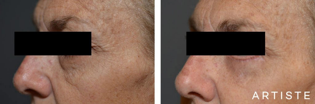 54 Year Old Lower Eyelid Blepharoplasty