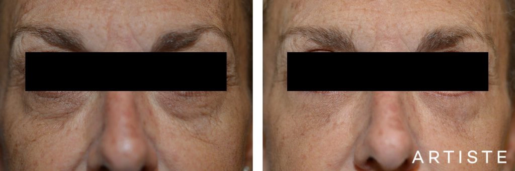 54 Year Old Lower Eyelid Blepharoplasty