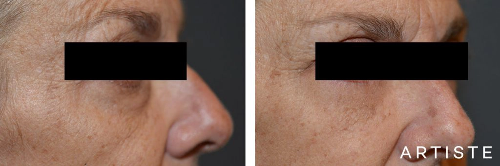 54 Year Old Lower Eyelid Blepharoplasty