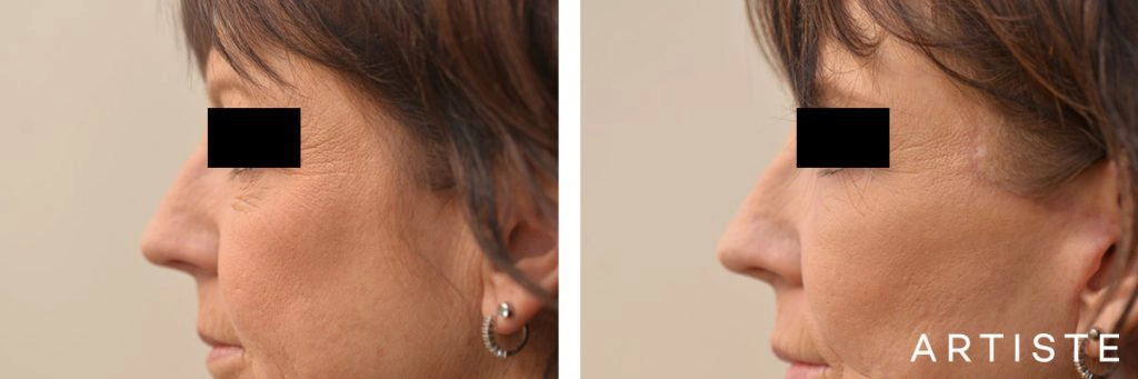 56 Year Old Lower Eyelids + Short Scar Facelift