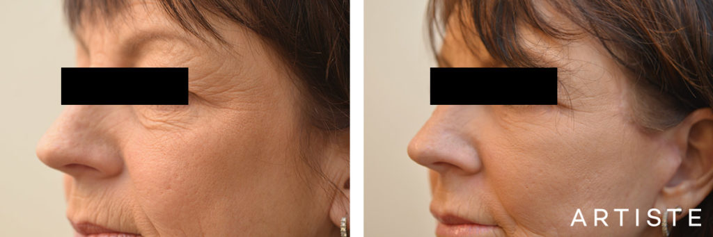 56 Year Old Lower Eyelids + Short Scar Facelift