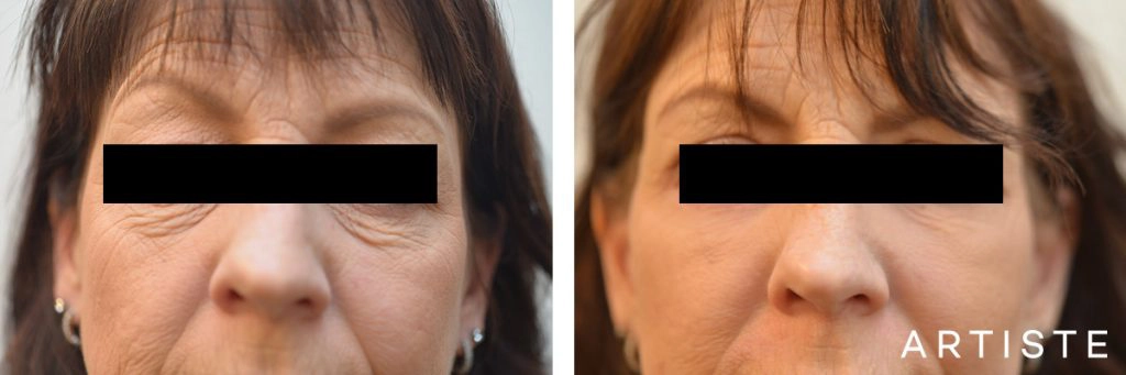 56 Year Old Lower Eyelids + Short Scar Facelift