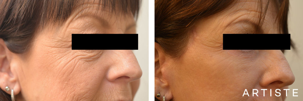 56 Year Old Lower Eyelids + Short Scar Facelift