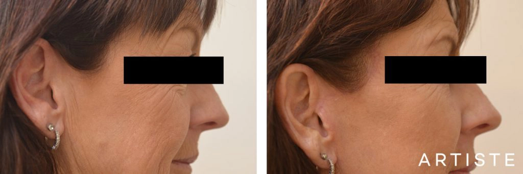 56 Year Old Lower Eyelids + Short Scar Facelift