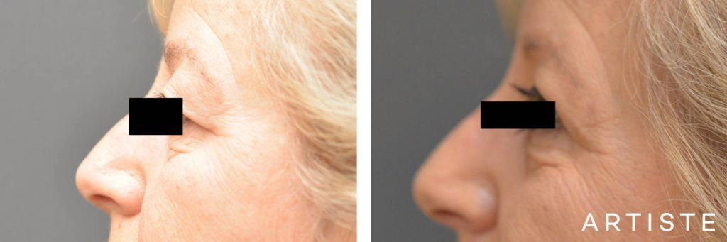 56 Year Old Open Eye Upper Blepharoplasty