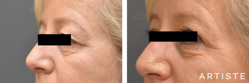 56 Year Old Open Eye Upper Blepharoplasty