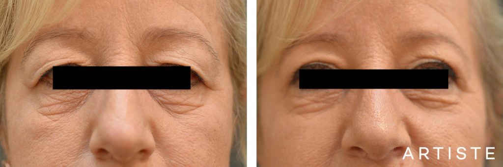 56 Year Old Open Eye Upper Blepharoplasty