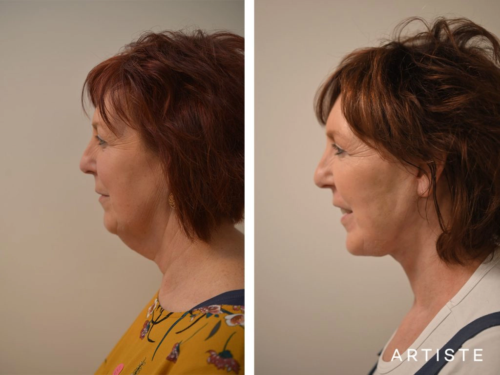 56 Year Old: High SMAS Face and Neck Lift, Structural Fat Grafting, Peri-Oral Dermabrasion