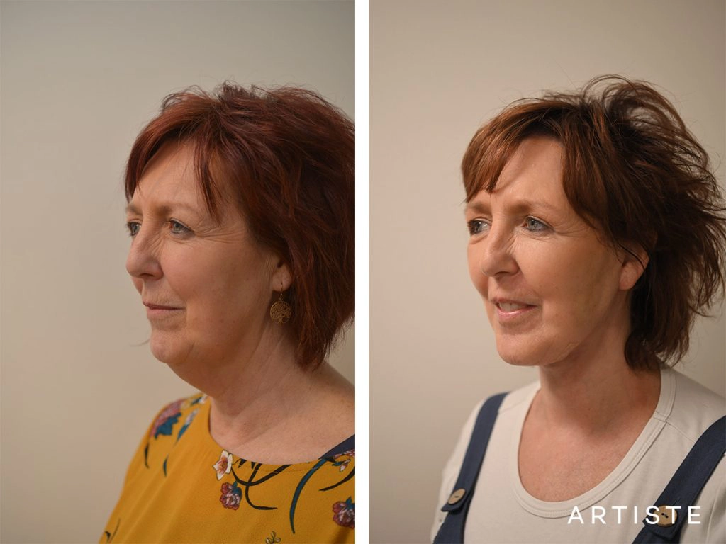 56 Year Old: High SMAS Face and Neck Lift, Structural Fat Grafting, Peri-Oral Dermabrasion