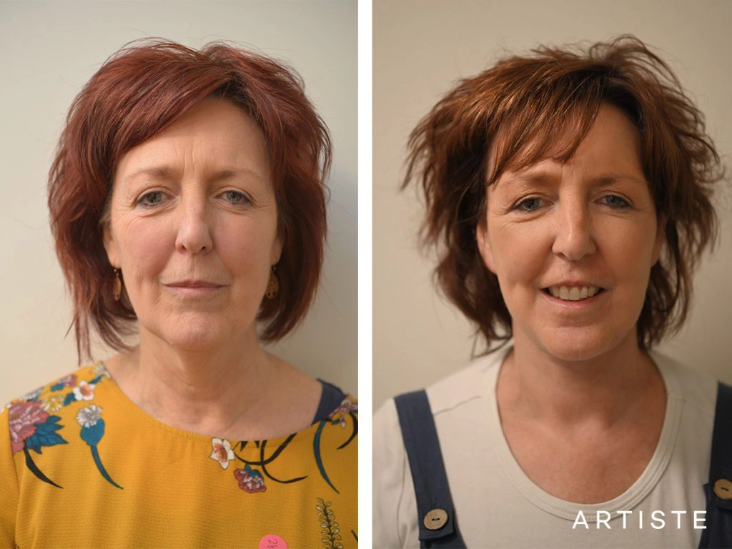 56 Year Old: High SMAS Face and Neck Lift, Structural Fat Grafting, Peri-Oral Dermabrasion