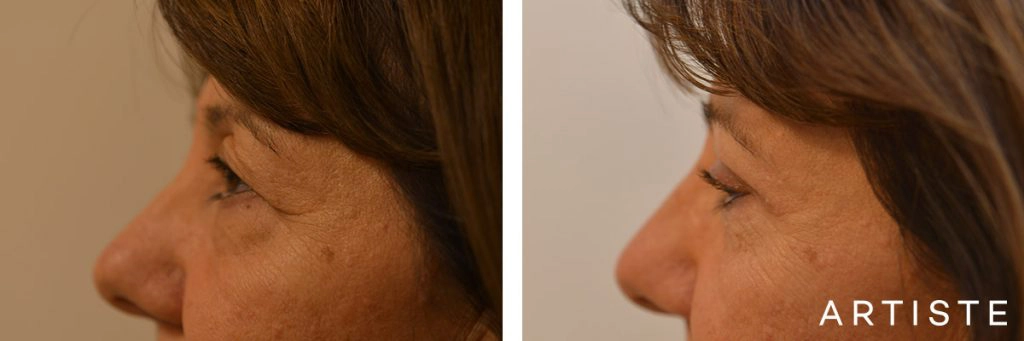 56 Year Old Upper Blepharoplasty Open Eyes