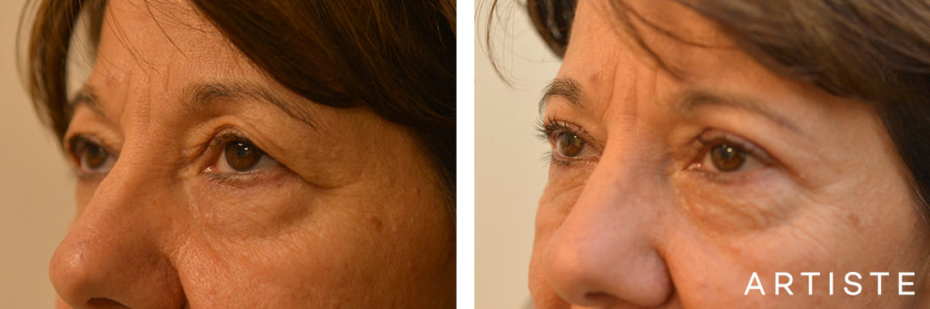 56 Year Old Upper Blepharoplasty Open Eyes