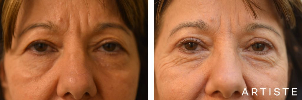 56 Year Old Upper Blepharoplasty Open Eyes