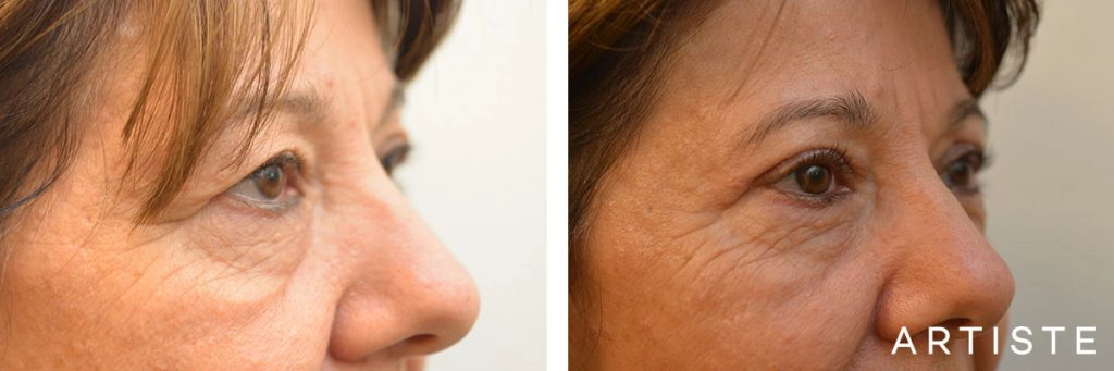 56 Year Old Upper Blepharoplasty Open Eyes