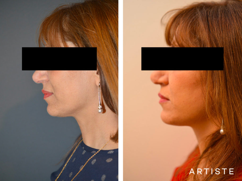 56 Year Old Signature Facelift