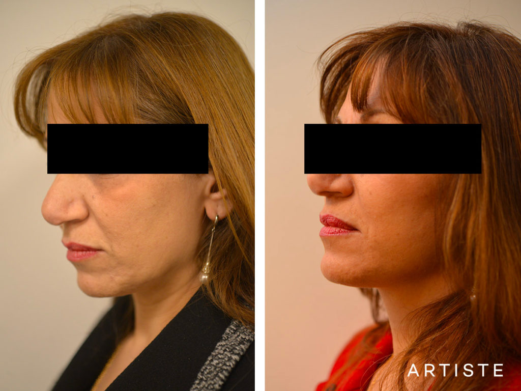 56 Year Old Signature Facelift