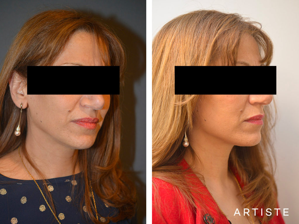 56 Year Old Signature Facelift