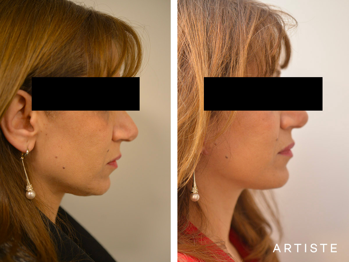 Post-COVID Facelift Procedure