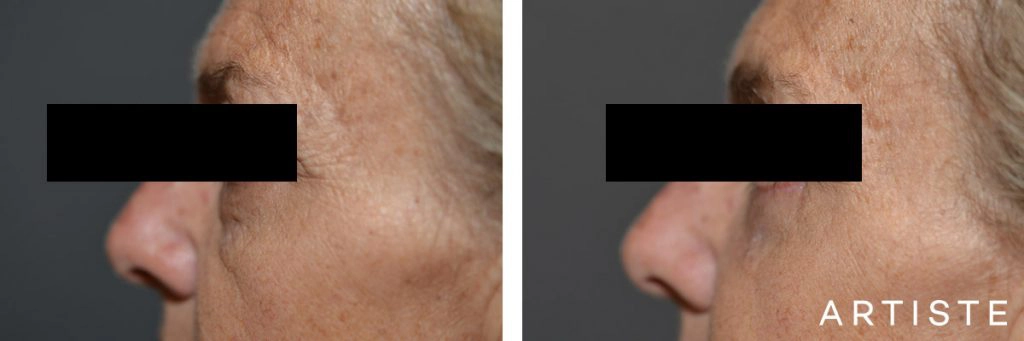 54 Year Old Lower Eyelid Blepharoplasty