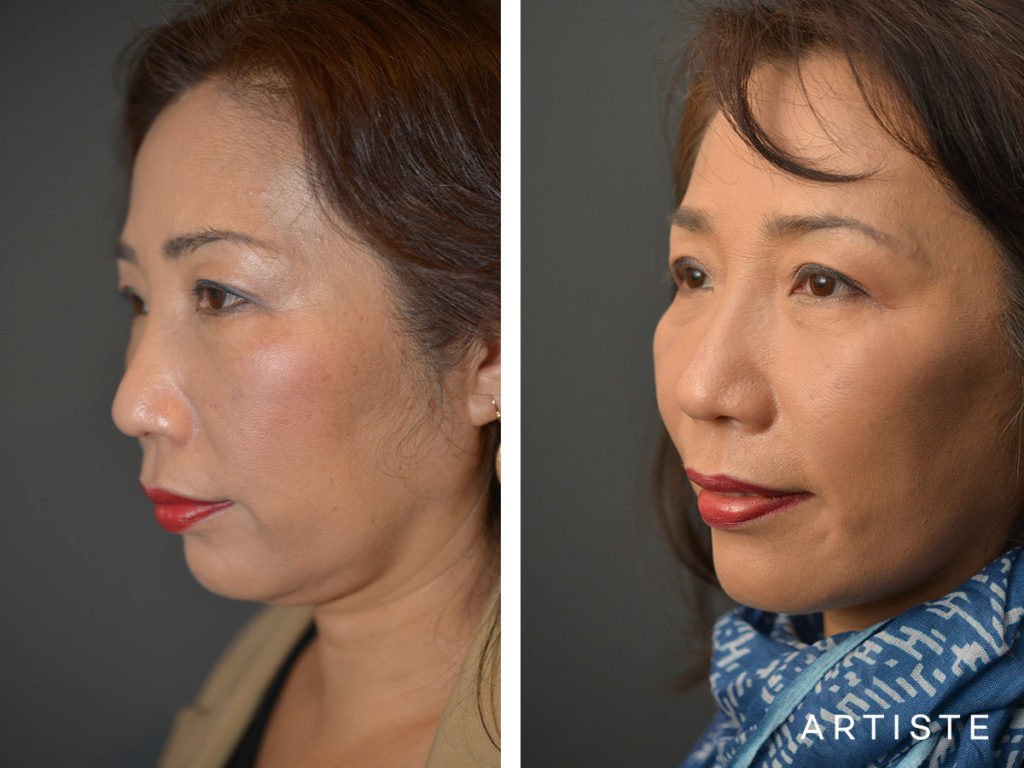 58 Year Old: Deep Plane Facelift