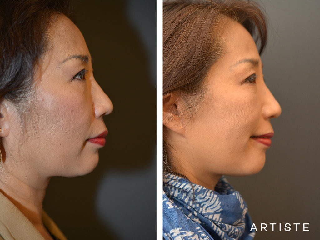 58 Year Old Signature Facelift