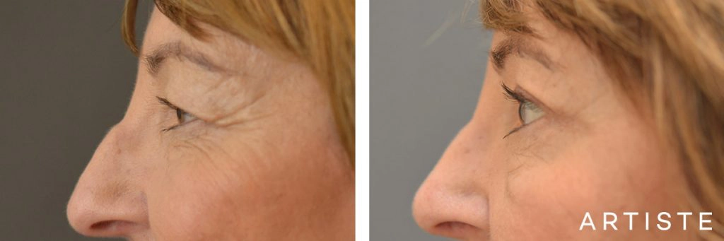 60 Year Old Open Eye, Upper Blepharoplasty + Rhinoplasty