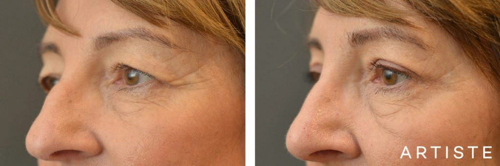 60 Year Old Open Eye, Upper Blepharoplasty + Rhinoplasty