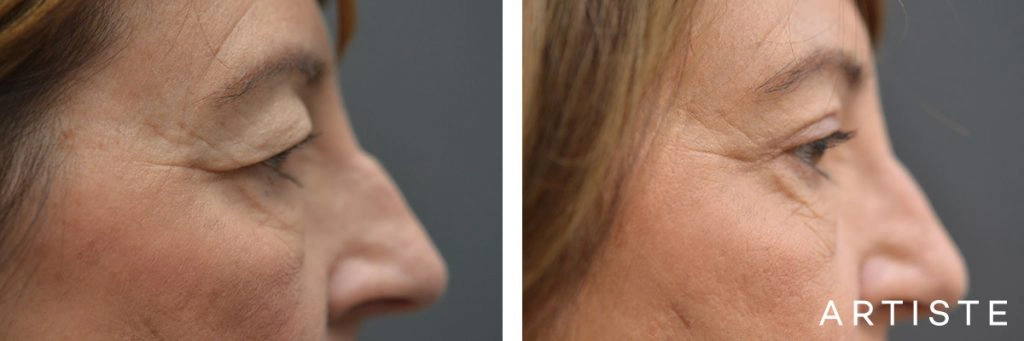 60 Year Old Open Eye, Upper Blepharoplasty + Rhinoplasty