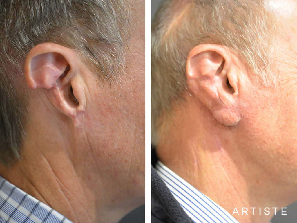 63 Year Old Partial Ear Reconstruction Trauma