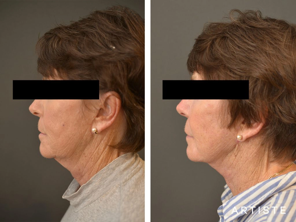 64 Years Old: High SMAS Face and Neck Lift, Structural Fat Grafting, Peri-Oral Dermabrasion, Chemical Peel