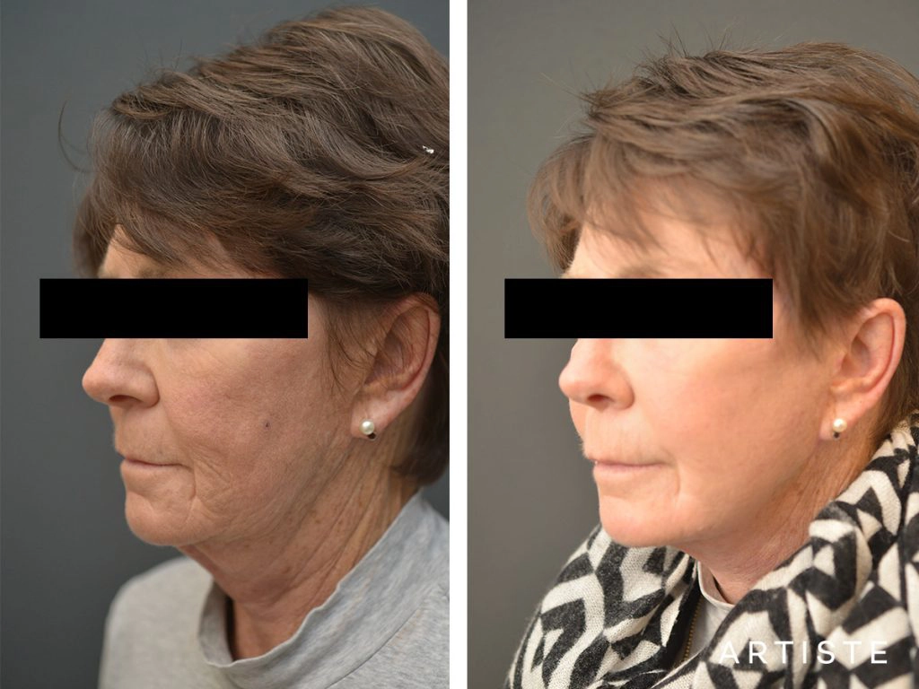 64 Years Old: High SMAS Face and Neck Lift, Structural Fat Grafting, Peri-Oral Dermabrasion, Chemical Peel