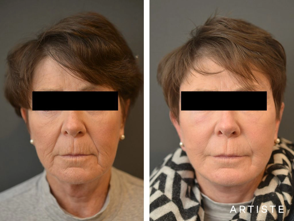 64 Years Old: High SMAS Face and Neck Lift, Structural Fat Grafting, Peri-Oral Dermabrasion, Chemical Peel