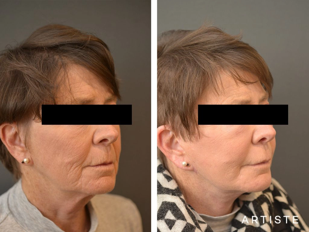 64 Years Old: High SMAS Face and Neck Lift, Structural Fat Grafting, Peri-Oral Dermabrasion, Chemical Peel