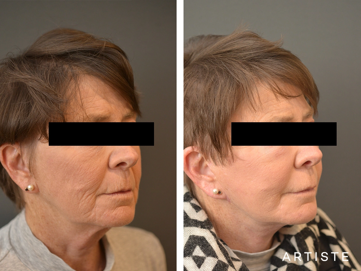 64-Year Old High SMAS Facelift and Neck Lift Patient