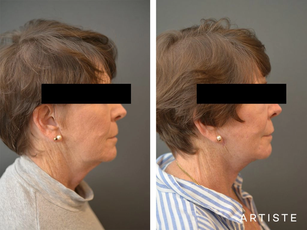 64 Years Old: High SMAS Face and Neck Lift, Structural Fat Grafting, Peri-Oral Dermabrasion, Chemical Peel