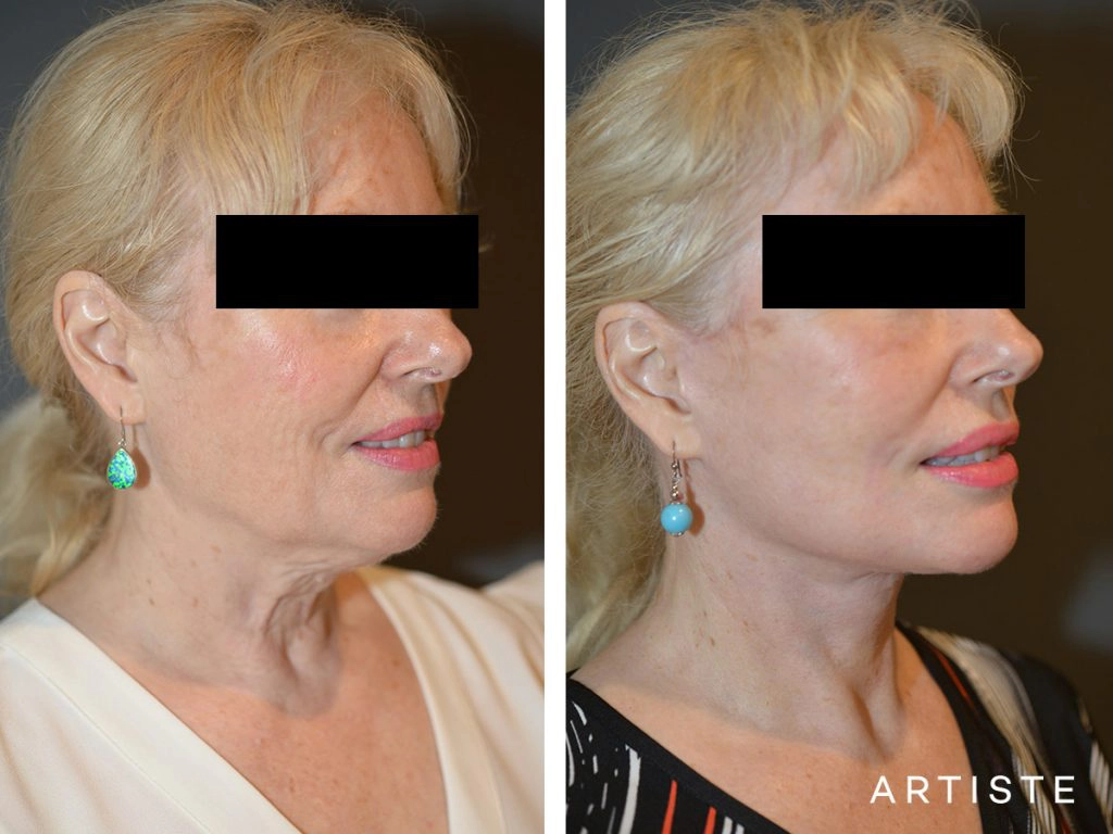 64 Years Old: High SMAS Face and Neck Lift, Structural Fat Grafting, Peri-Oral Dermabrasion, Chemical Peel