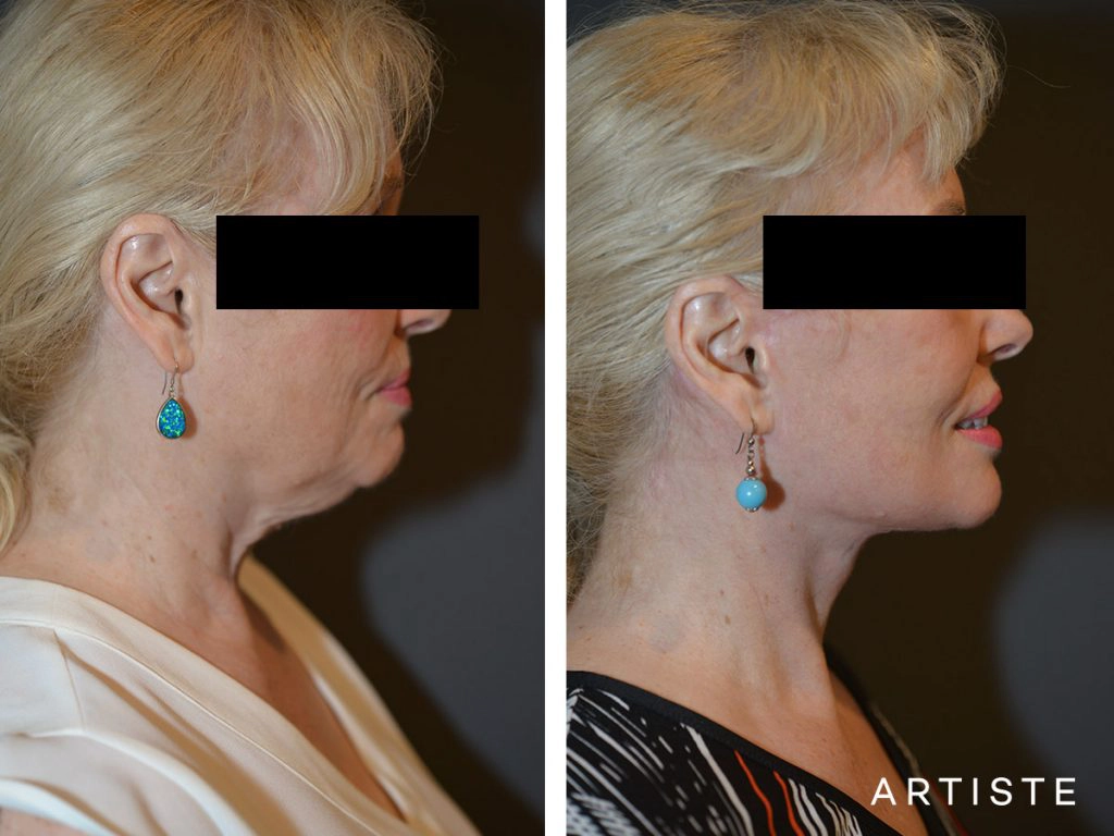 64 Years Old: High SMAS Face and Neck Lift, Structural Fat Grafting, Peri-Oral Dermabrasion, Chemical Peel