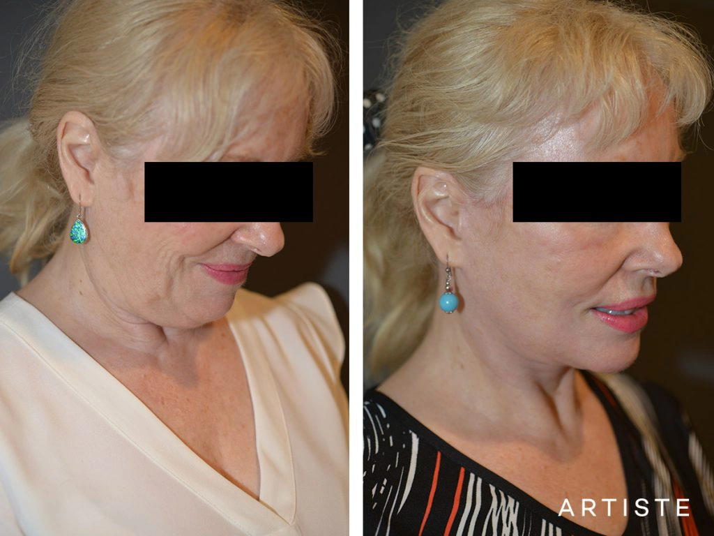 64 Years Old: High SMAS Face and Neck Lift, Structural Fat Grafting, Peri-Oral Dermabrasion, Chemical Peel