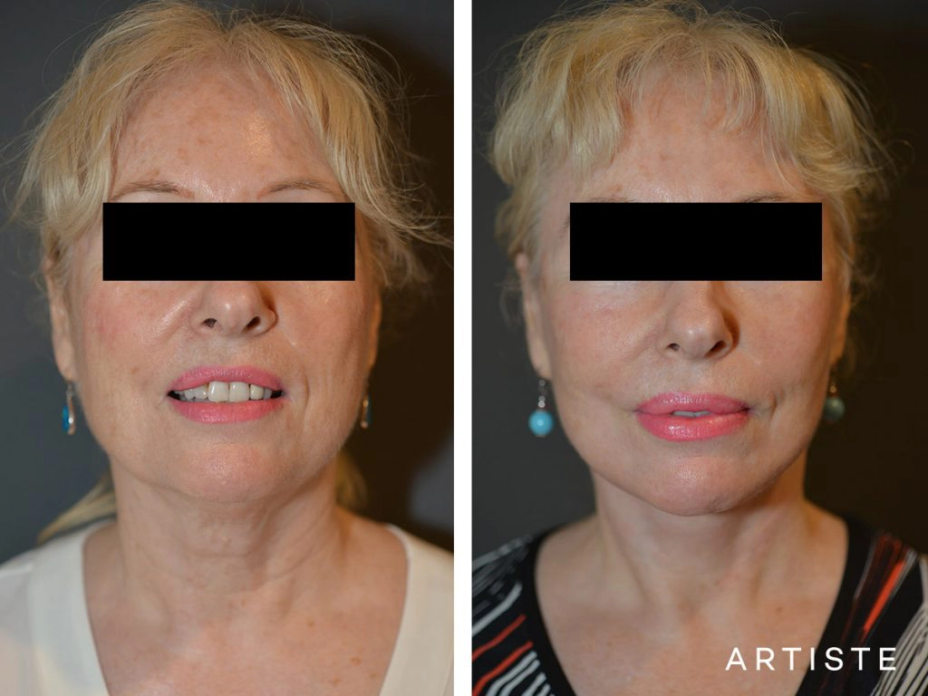 64 Years Old: High SMAS Face and Neck Lift, Structural Fat Grafting, Peri-Oral Dermabrasion, Chemical Peel