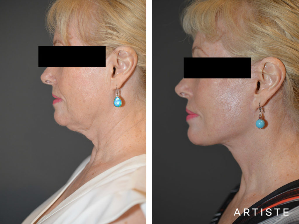64 Years Old: High SMAS Face and Neck Lift, Structural Fat Grafting, Peri-Oral Dermabrasion, Chemical Peel