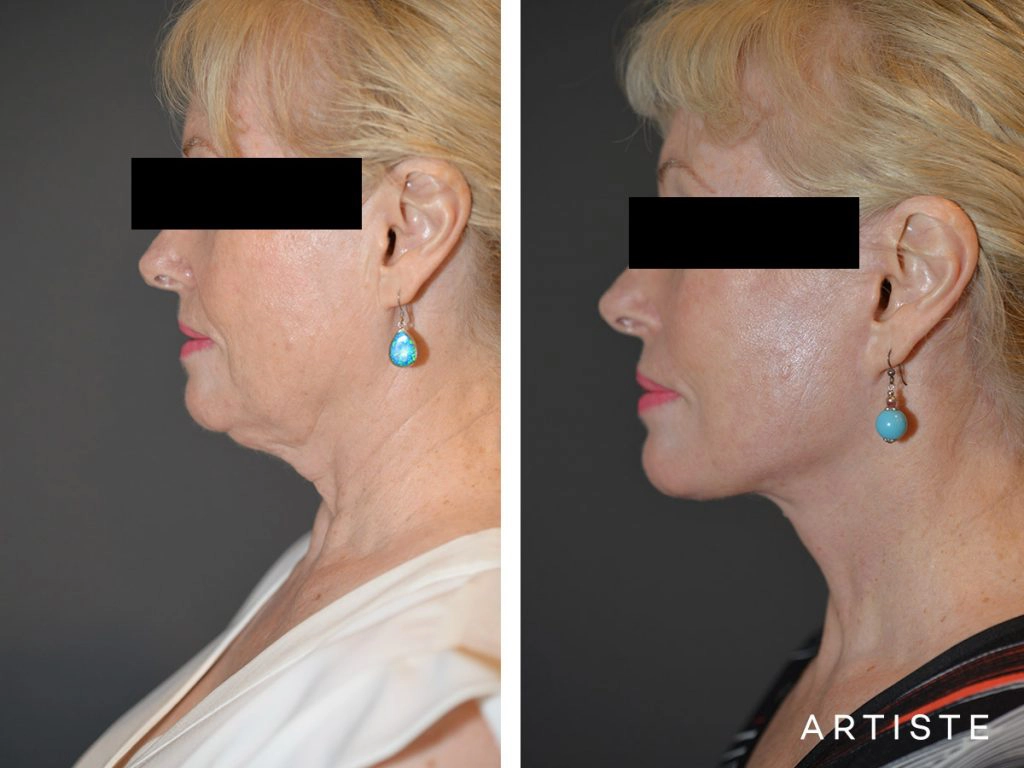 64 Years Old: High SMAS Face and Neck Lift, Structural Fat Grafting, Peri-Oral Dermabrasion, Chemical Peel