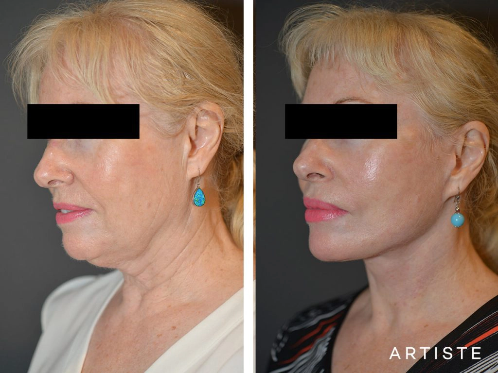 64 Years Old: High SMAS Face and Neck Lift, Structural Fat Grafting, Peri-Oral Dermabrasion, Chemical Peel