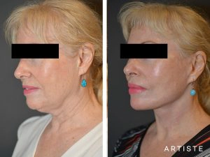 64 Year Old Face Lift​ at Artiste